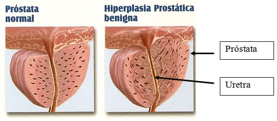 Próstata: Hiperplasia prostática benigna (HPB)