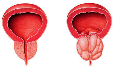 Prostatite Rins e vias urinárias
