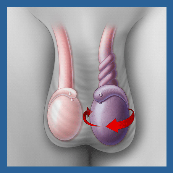 Torção testicular